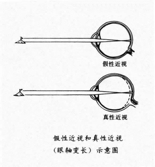 嗨視力專業(yè)驗(yàn)光配鏡丨孩子遇上 假 性近視,先別著急配眼鏡